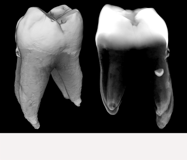 Volume reconstruction of a four rooted maxillary first molar