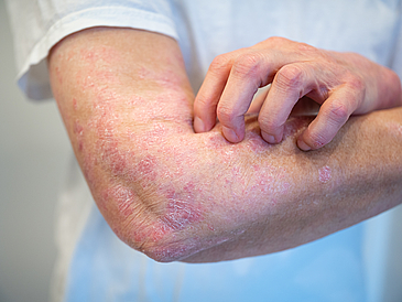 Many people suffer from eczema and psoriasis. 