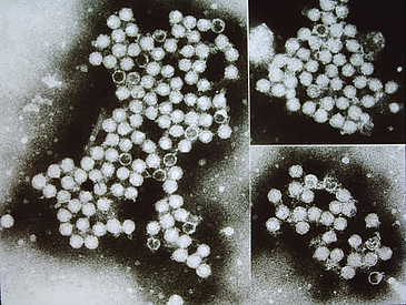 Elektronenmikroskopische Aufnahmen von Hepatitis A-Viren
