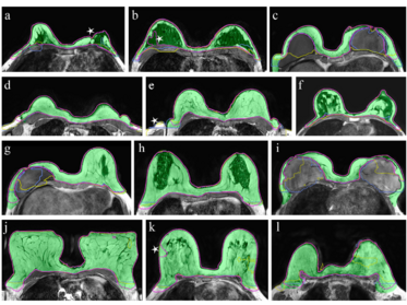 Verschiedene Segmentierungen der Brust auf MRT Daten