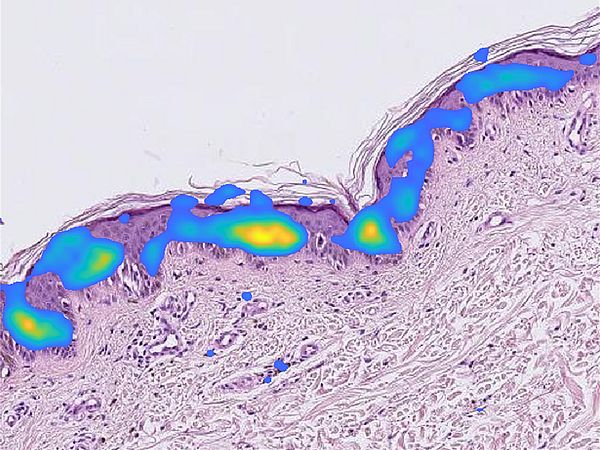 Visualisierung von KI-Ergebnissen zur Krebserkennung