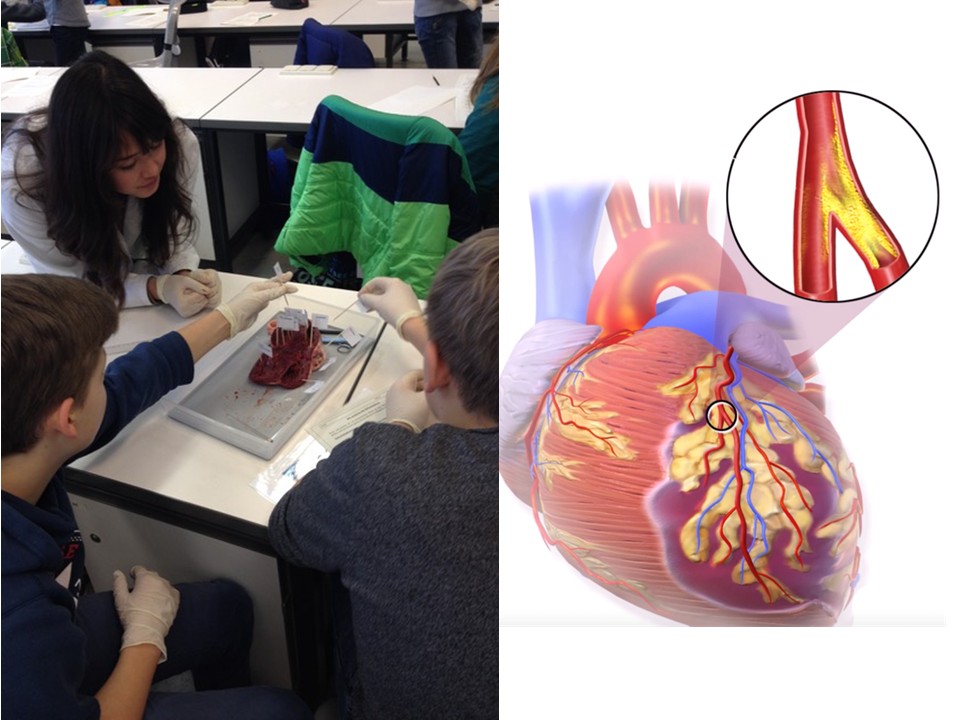 Herzen sachgerecht präparieren Links: Eine Dozentin und zwei Schüler sitzen an einem Tisch, auf dem ein Herz-Präparat liegt, das sie mit Hilfe von Schildern an Zahnstochern beschriften. Rechts: Zeichnung eines Herzens sowie eine Vergrößerung eines Bildausschnitts der Herzkranzgefäße. In der Vergrößerung sieht man Ablagerungen und damit eine Verengung der Arterien.