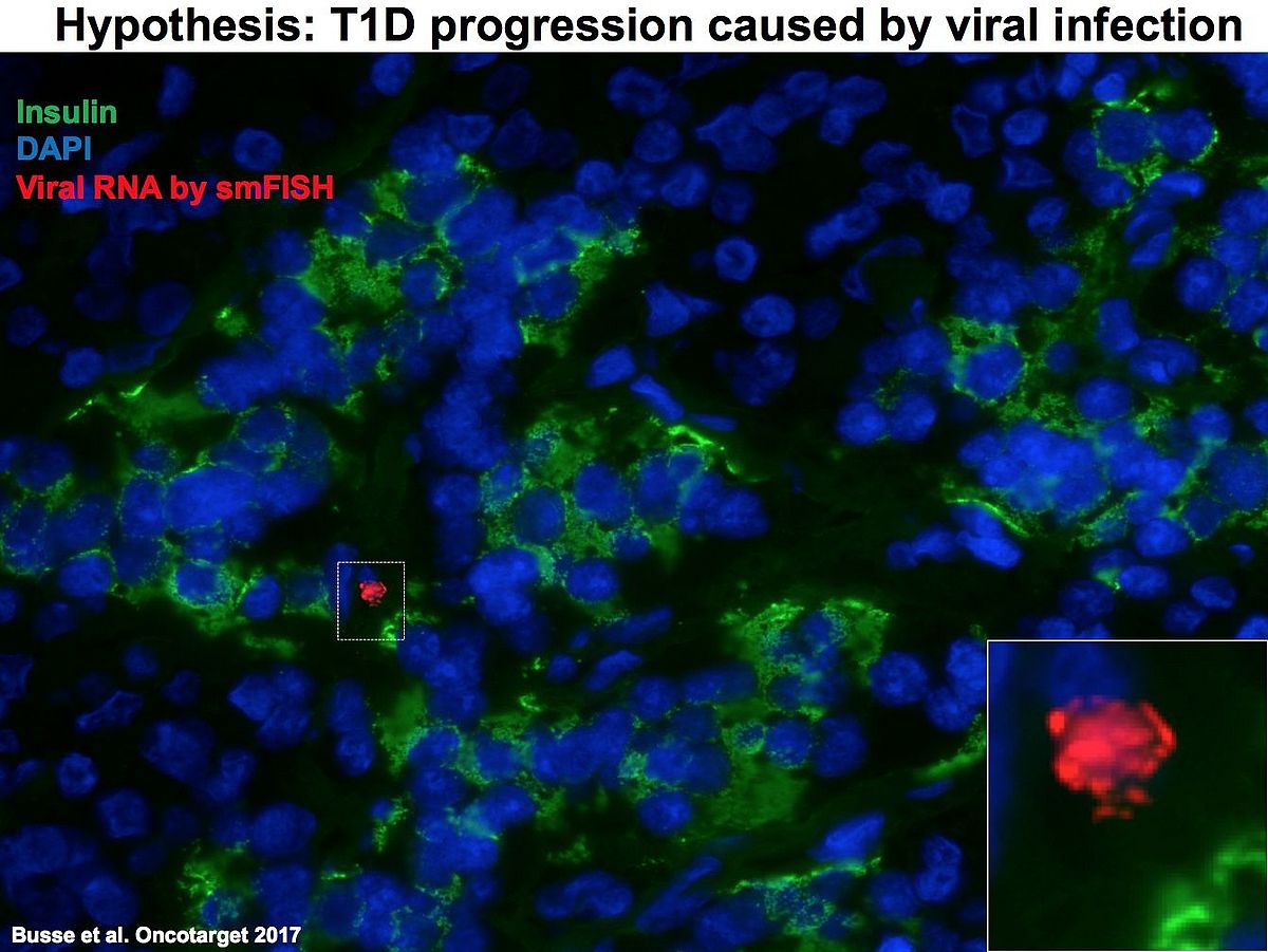 Detection and localization of viral infection microscopic image of viral infection in the pancreas